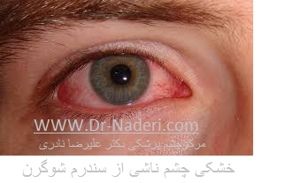 سندرم شوگرن Sjögrens Syndrome