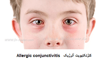  Allergic conjunctivitis کنژنکتیویت آلرژیک