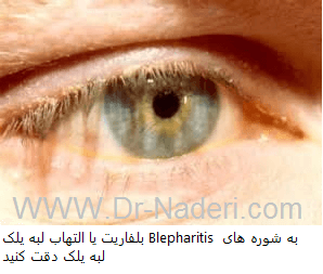 بلفاریت یا التهاب لبه پلک blepharitis or eyelid inflammation