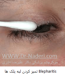 بلفاریت یا التهاب لبه پلک blepharitis or eyelid inflammation