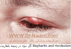 بلفاریت یا التهاب لبه پلک blepharitis or eyelid inflammation