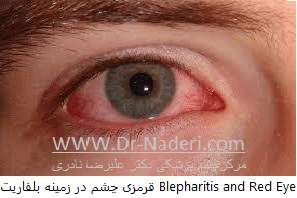 بلفاریت یا التهاب لبه پلک blepharitis or eyelid inflammation