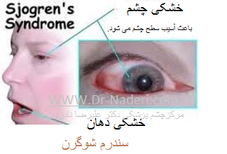 Sjögrens Syndrome سندرم شوگرن 