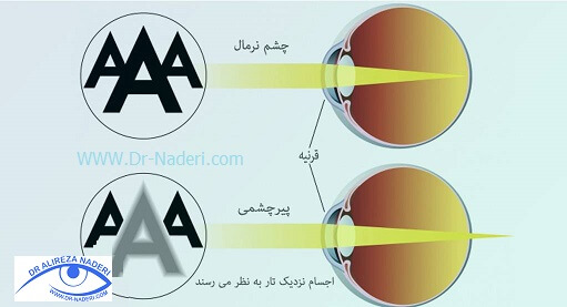 سوالات رایج درباره پیرچشمی Presbyopia Frequent Asked Questions