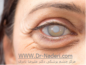 پیشرفته ترین روش جراحی آب مروارید Best Cataract Surgery Method